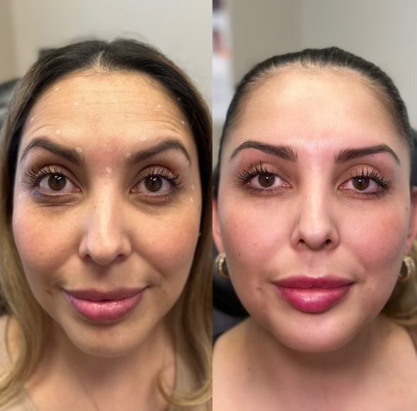 Before-and-after photos of a woman. Left side, before wrinkles. Right side, smoother skin and fuller lips.