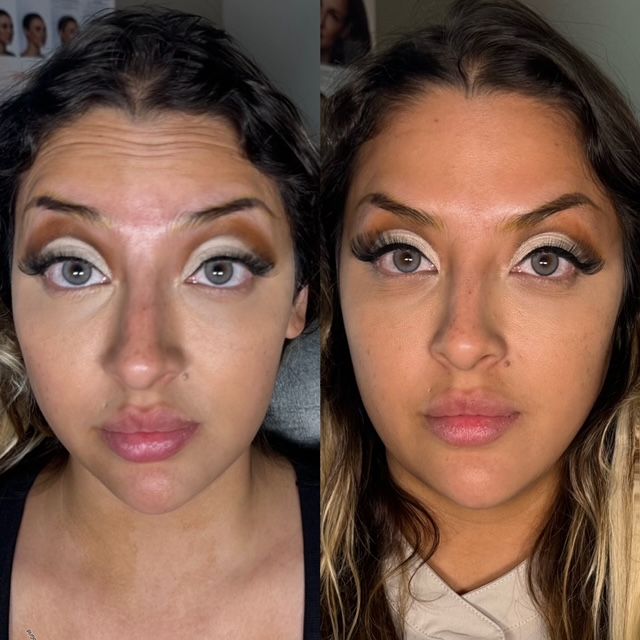 Side-by-side before/after photos of a woman's face; wrinkles are visibly reduced.