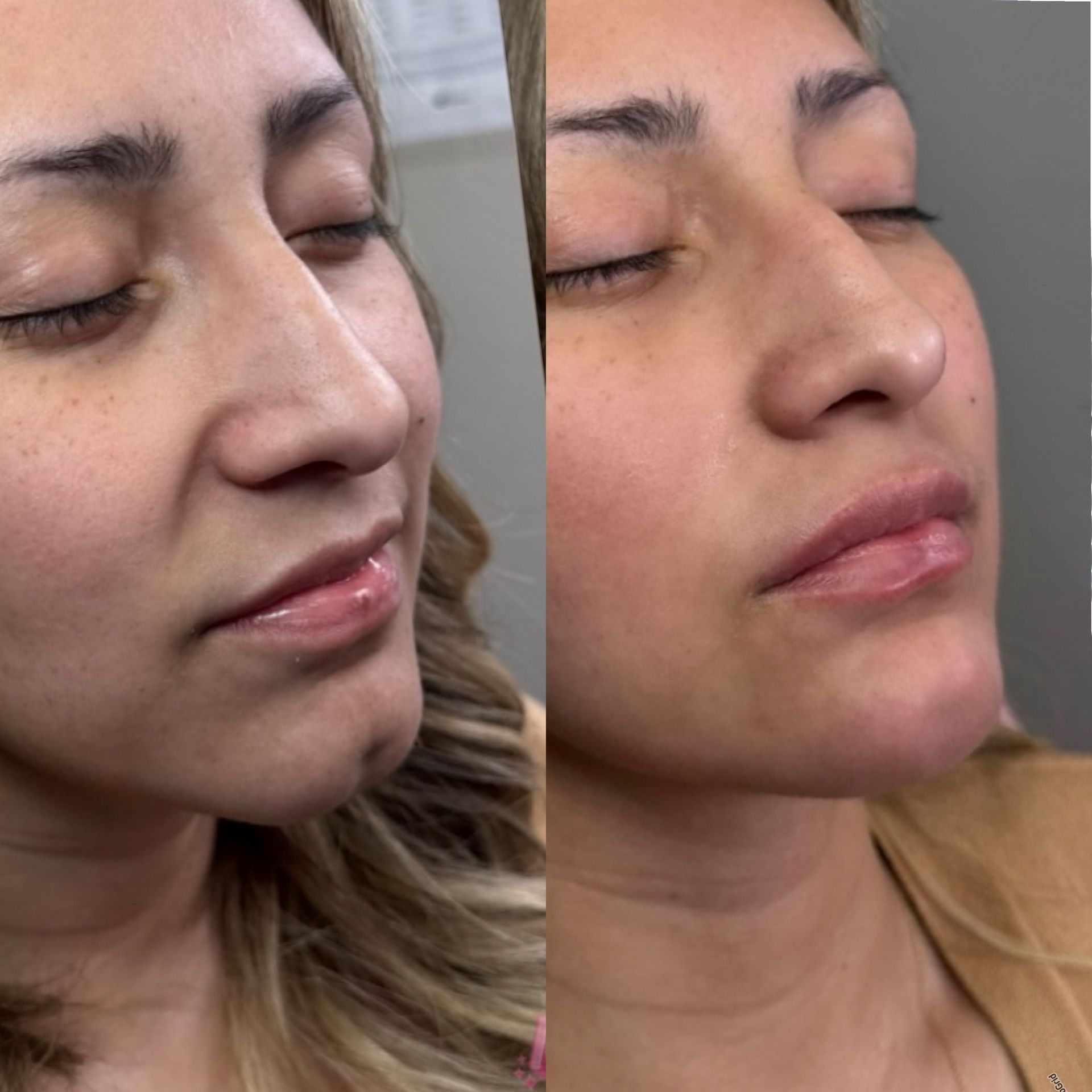 Before-and-after photos of a woman's face. Lip filler is the focus; her lips look plumper in the 