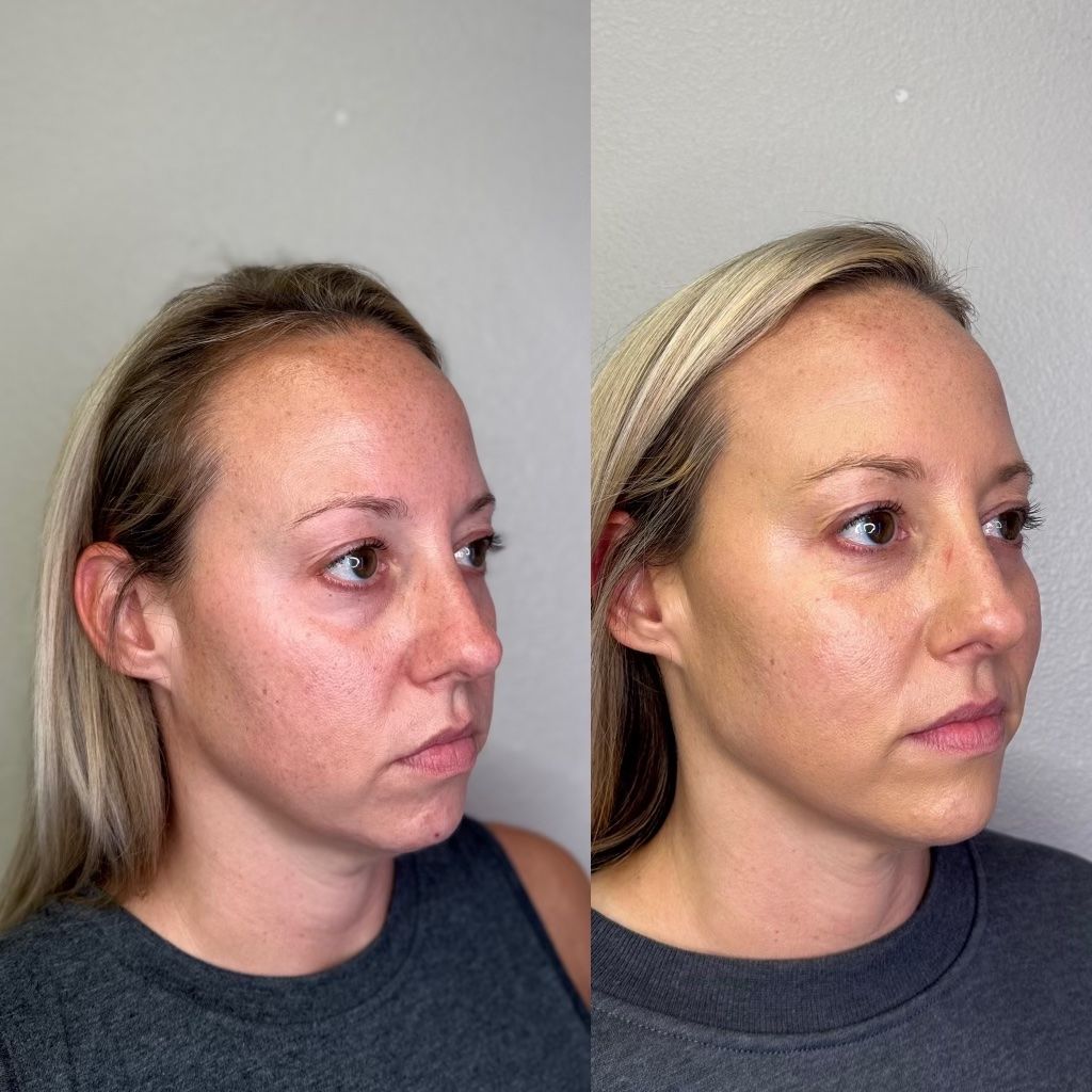 Side-by-side photos of a woman's face. Right side shows improved cheek and jawline definition.