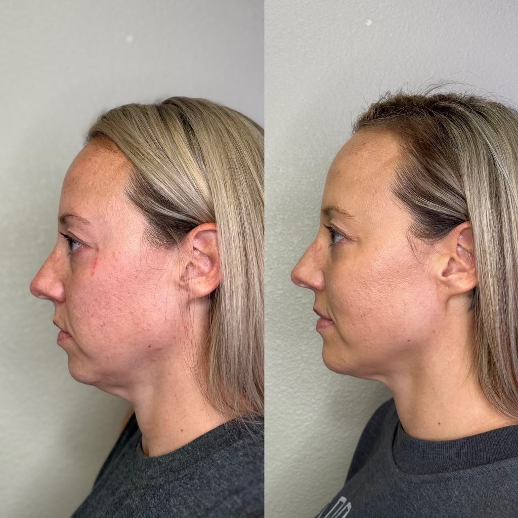 Side-by-side comparison: Before and after, woman's profile view, showing reduced submental fullness after procedure.