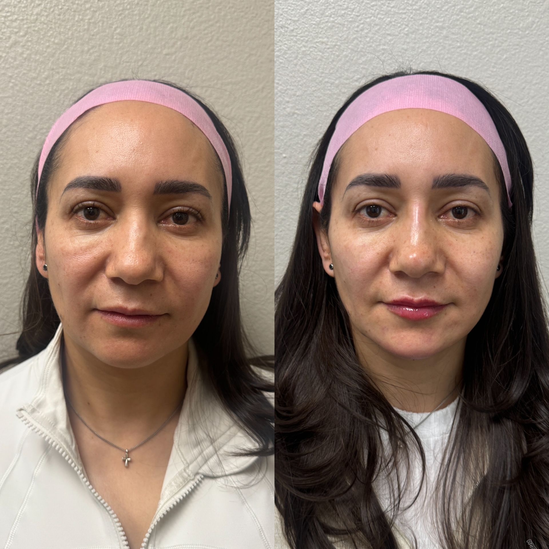 Side-by-side comparison of a woman's face, before and after cosmetic procedure. She wears a pink headband and has a visible complexion change.