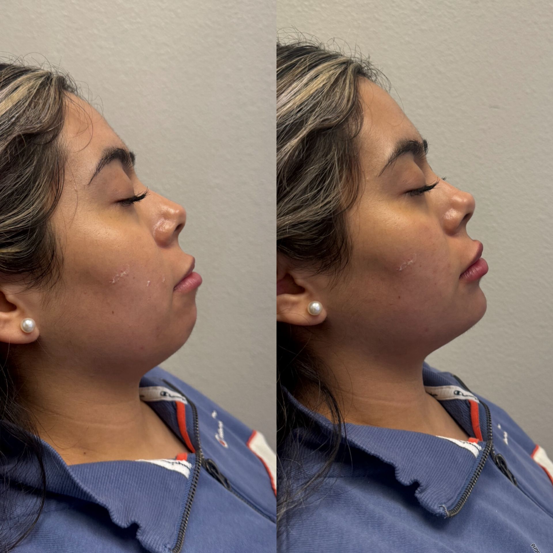 Side-by-side view of woman's profile. Before and after chin enhancement, showing improved jawline definition.