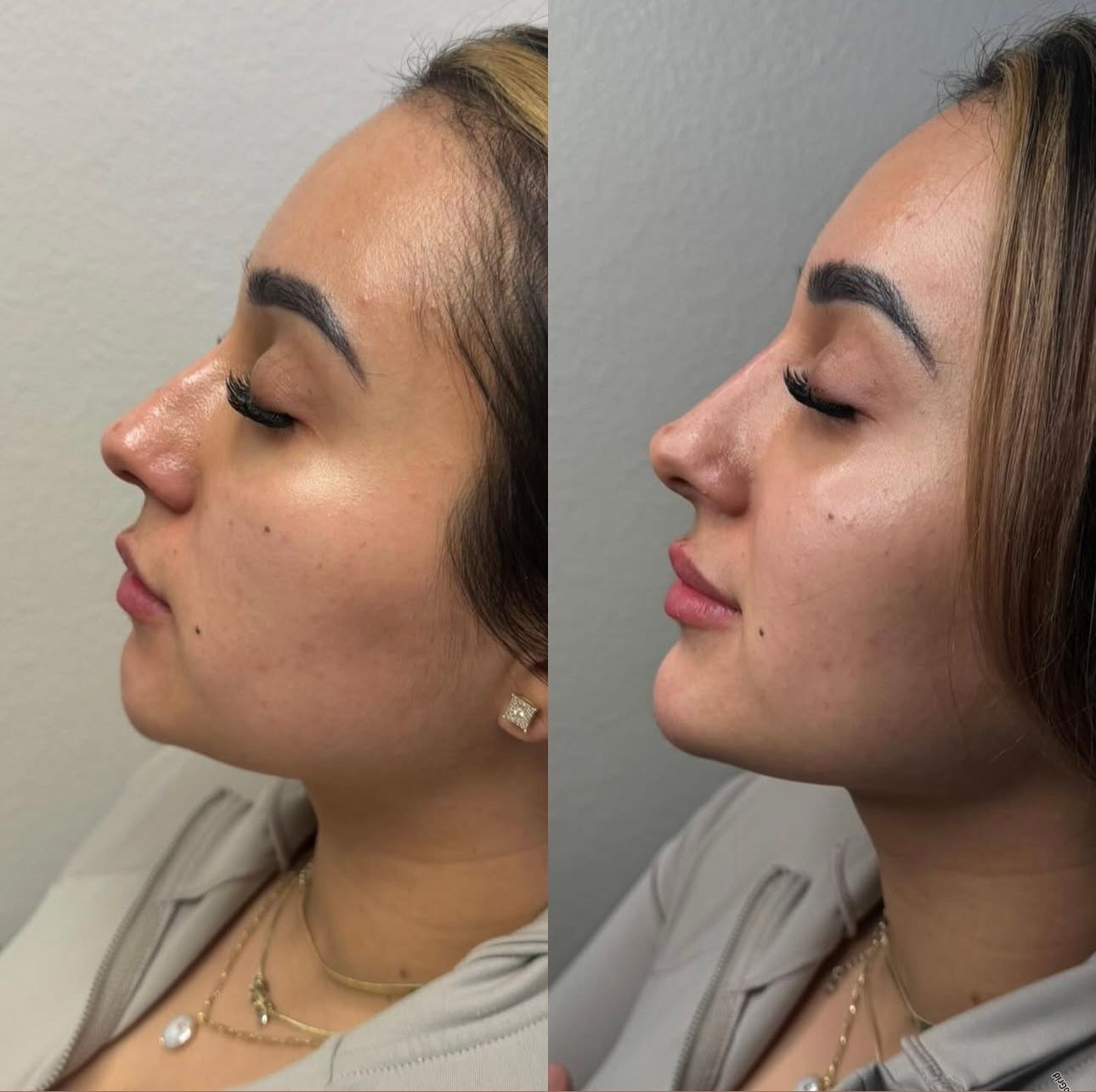 Side-by-side photos of a woman's profile before and after a cosmetic nose procedure; changes include a straighter nose.