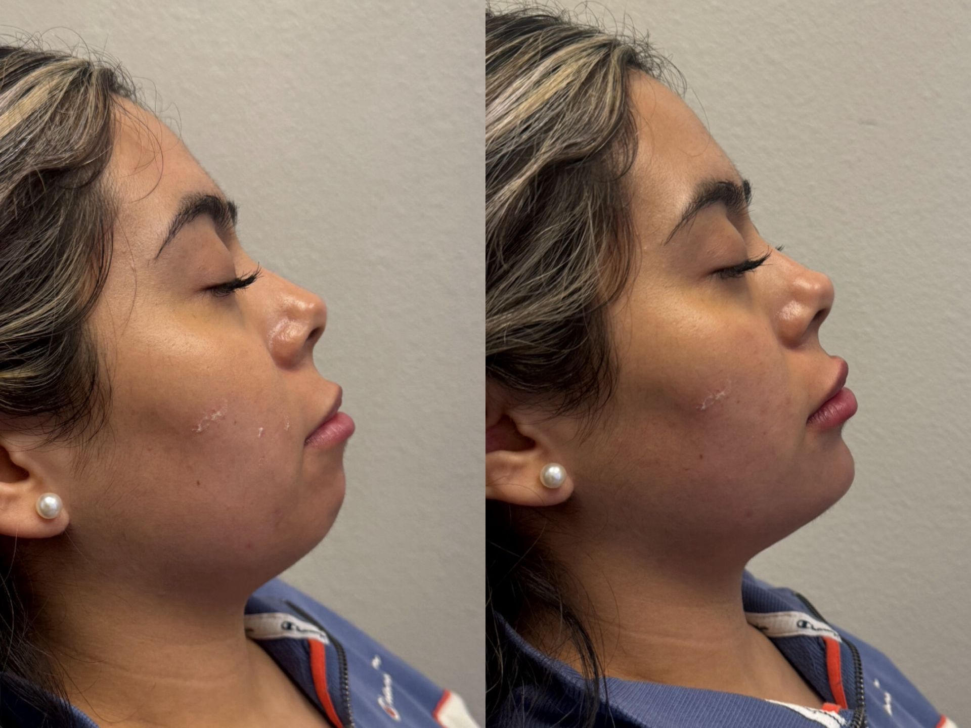 Two side-profile portraits of a woman, before and after a chin augmentation. Light skin, closed eyes, neutral expression.