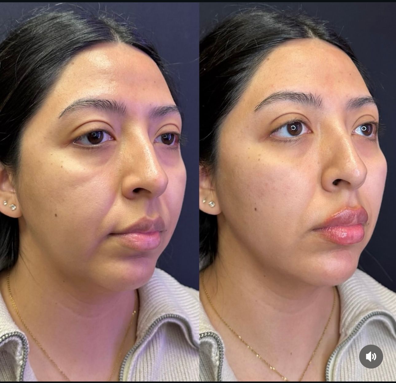 Side-by-side photos showing a woman's face. Left: before cosmetic procedures. Right: after lip and cheek filler.