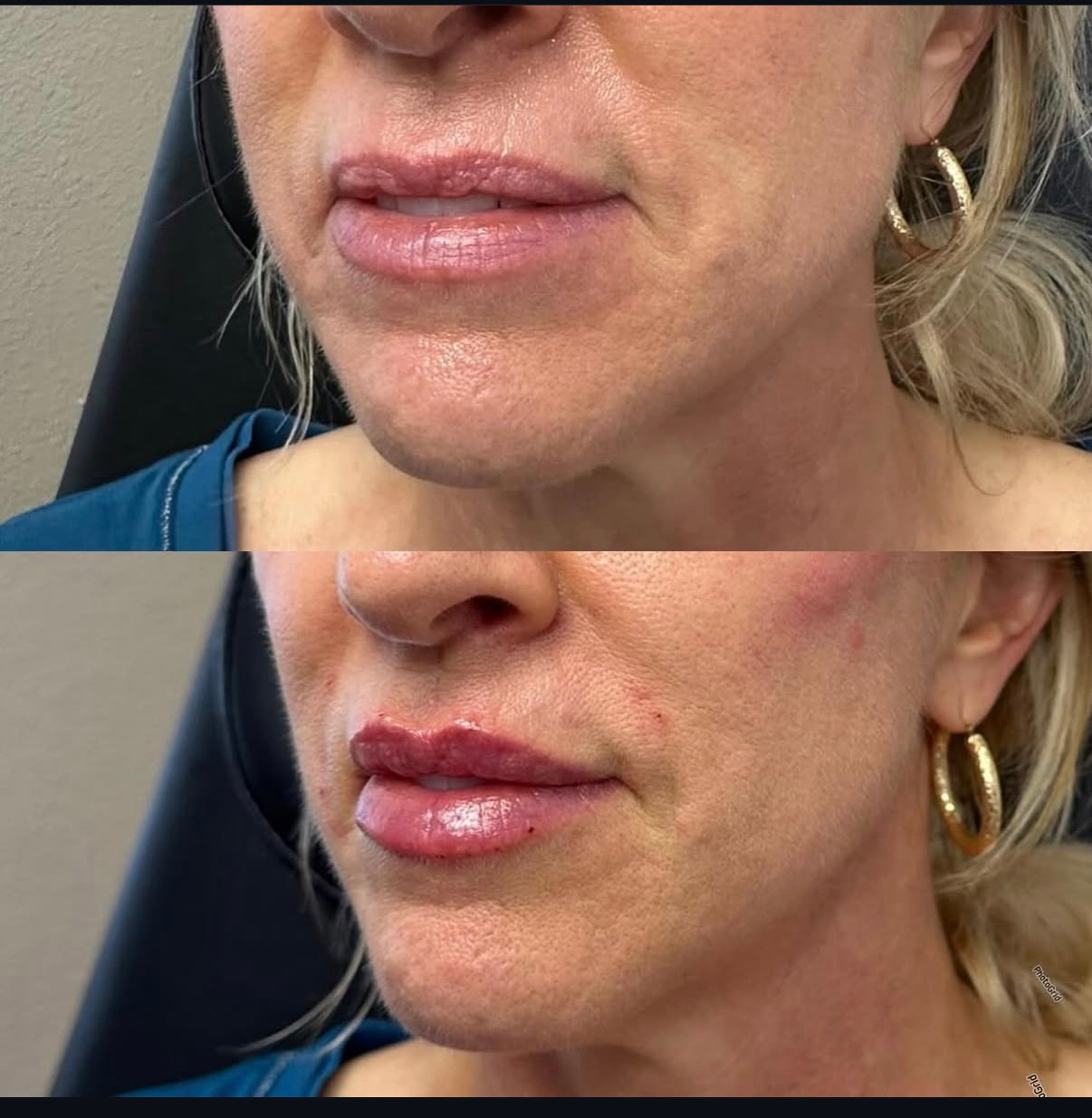 Before-and-after of woman's lips; top shows thinner lips, bottom shows enhanced lips with filler.