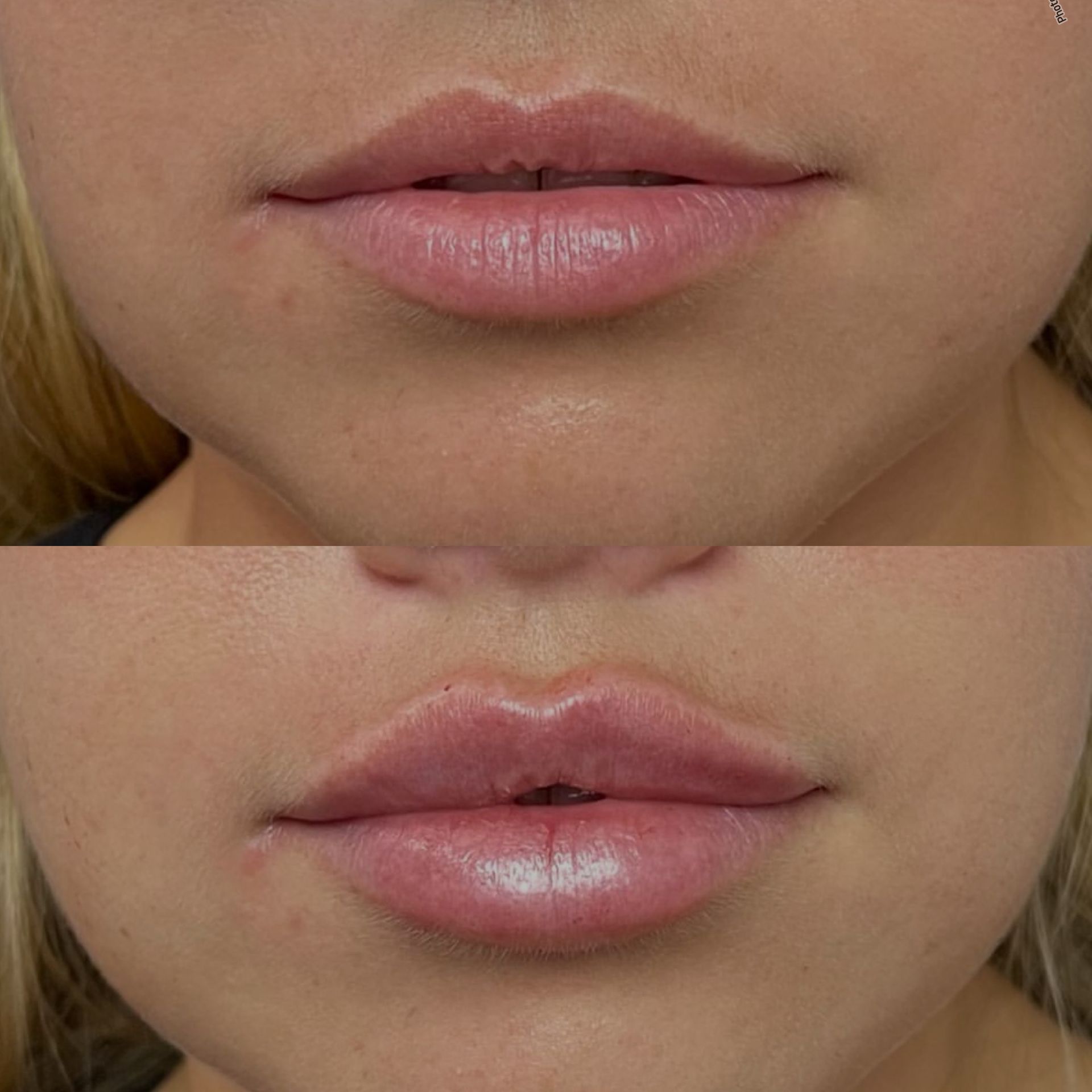 Top: Before lip enhancement, natural lips. Bottom: After lip enhancement, fuller lips.
