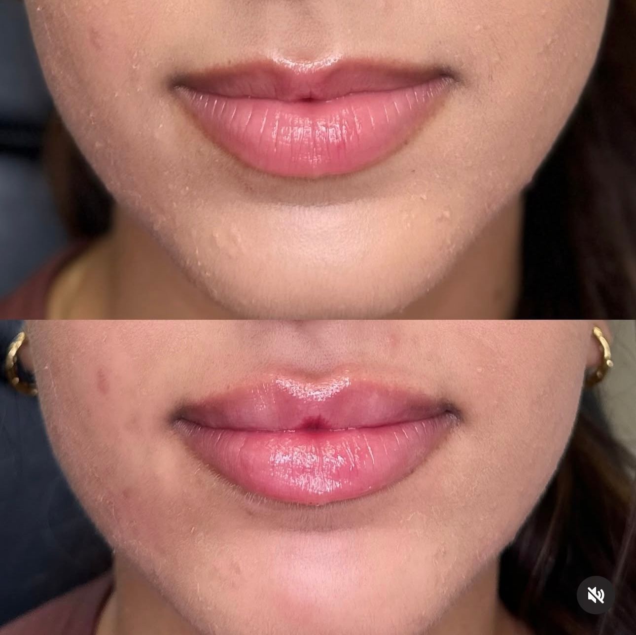 Before-and-after of lip injections: upper image shows thin lips, lower shows fuller lips.