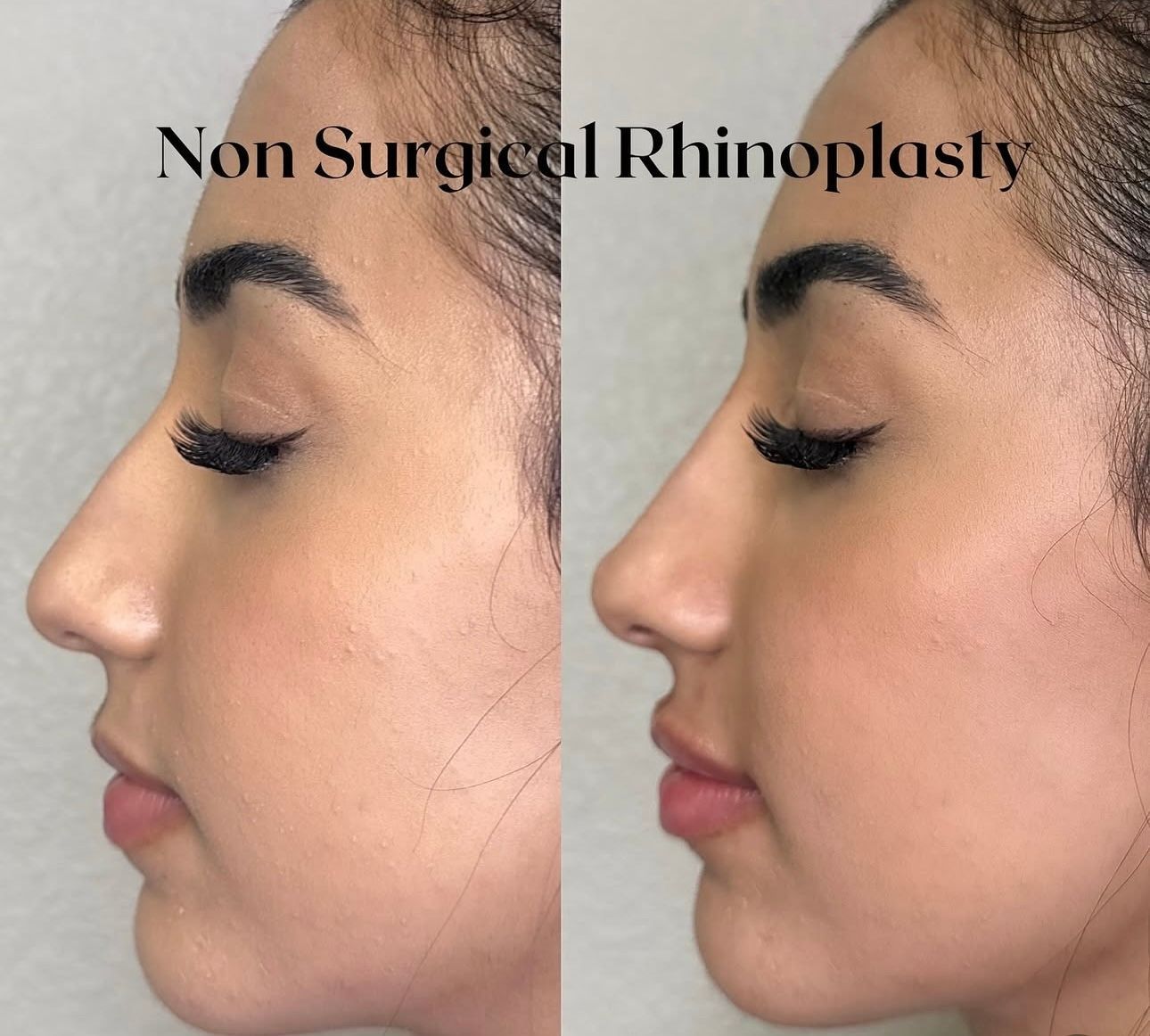 Side-by-side comparison of a woman's profile; before and after non-surgical rhinoplasty. Changes nose shape.