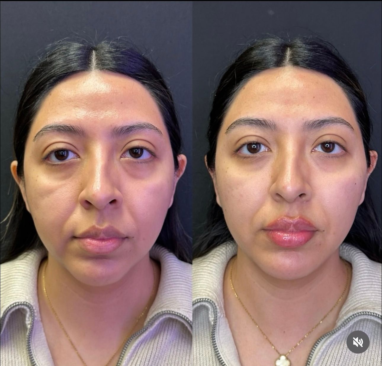 Side-by-side facial comparison. Woman's face before and after cosmetic procedure, lips fuller, skin tighter.