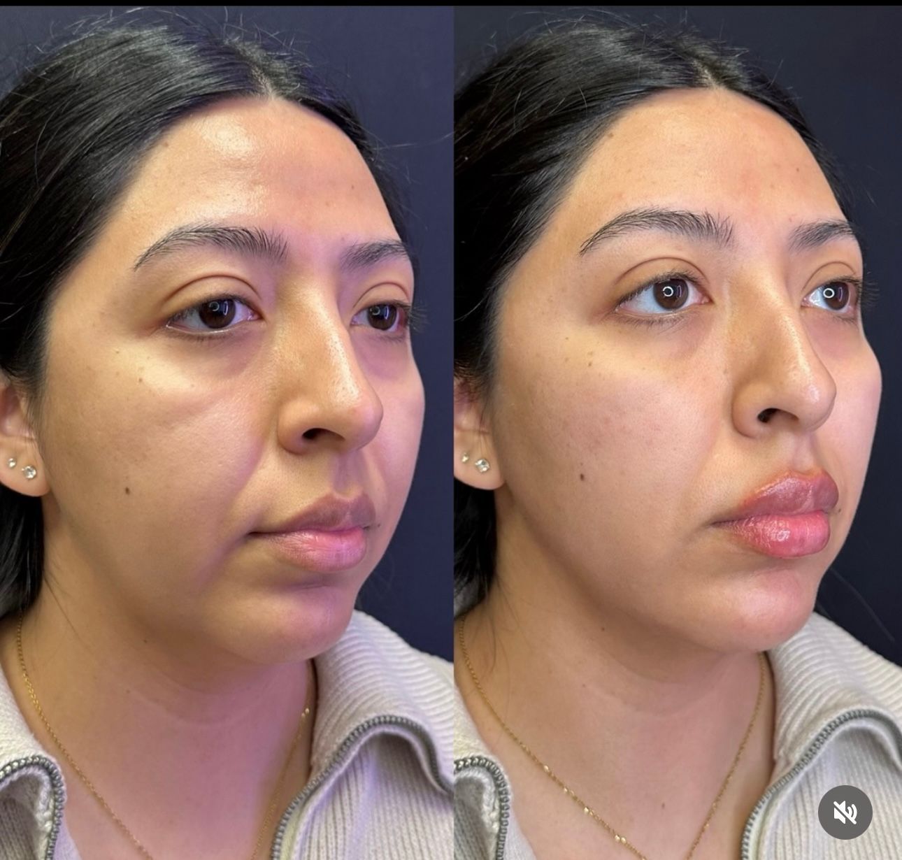 Side-by-side comparison of a woman's face: before and after cosmetic procedure, with fuller lips and jawline.