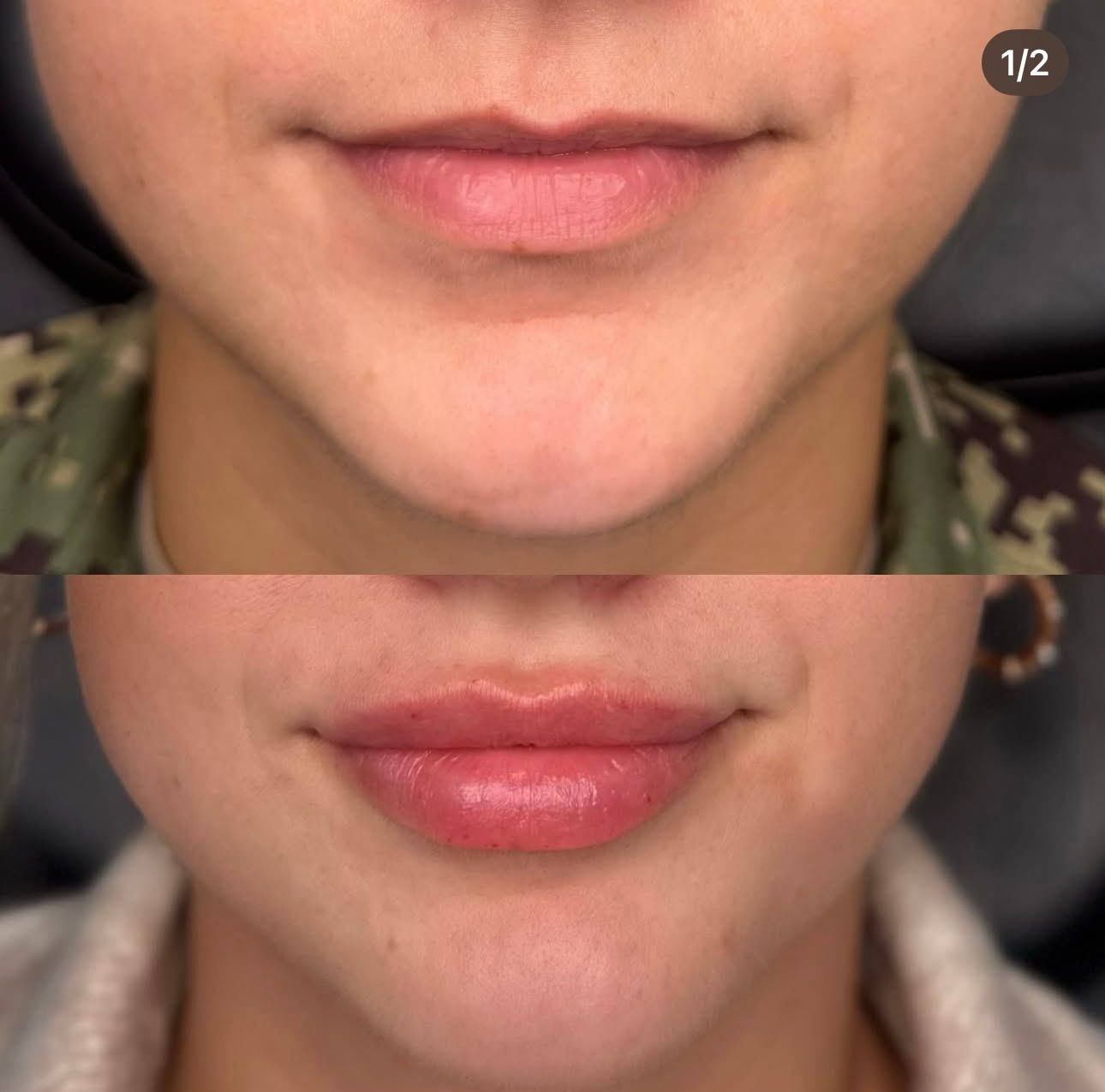 Top: Before lip filler. Bottom: After lip filler. Lips appear fuller and more defined.