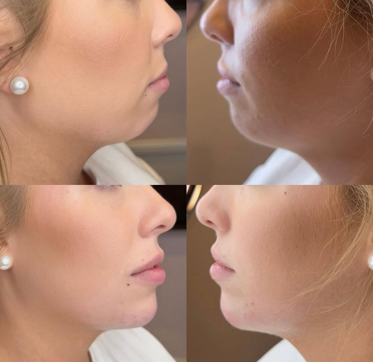 Four side-profile photos of a woman's face, showing before and after jawline enhancement; fair skin, pearl earrings.