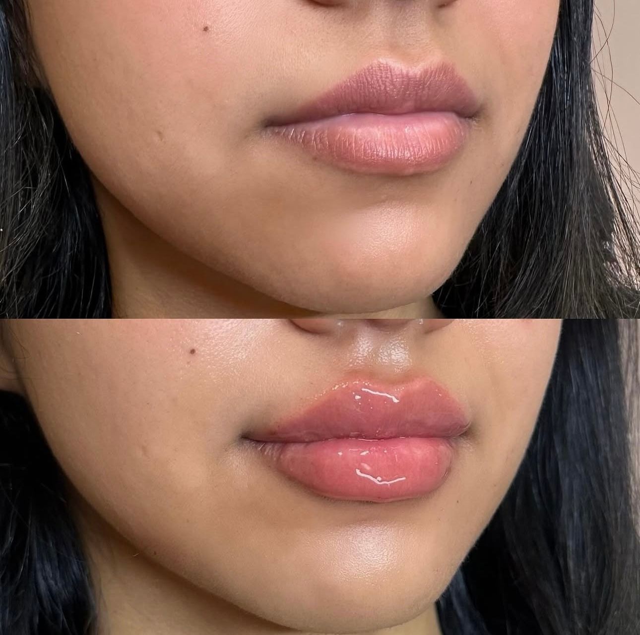 Comparison of woman's lips before (top) and after (bottom) lip injections; lips appear fuller and glossier after.