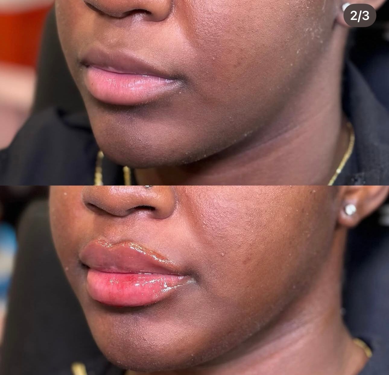 Before and after lip filler: dark-skinned person with thinner, then fuller, pink, glossy lips.