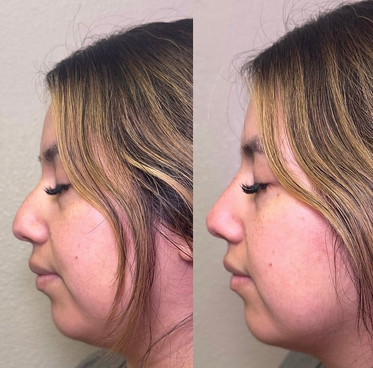 Before and after photos of a woman’s profile, showing a nose reshaping procedure.