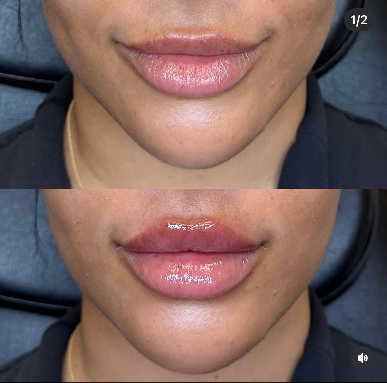 Two sets of lips; top set before, bottom after lip filler injection, both with glossy finish.