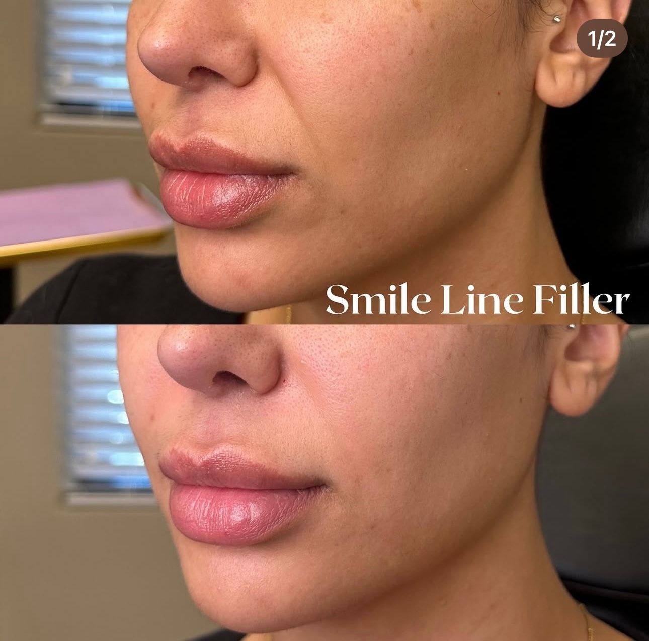 Before and after photos of a person's face, showing lip and smile line filler treatment.