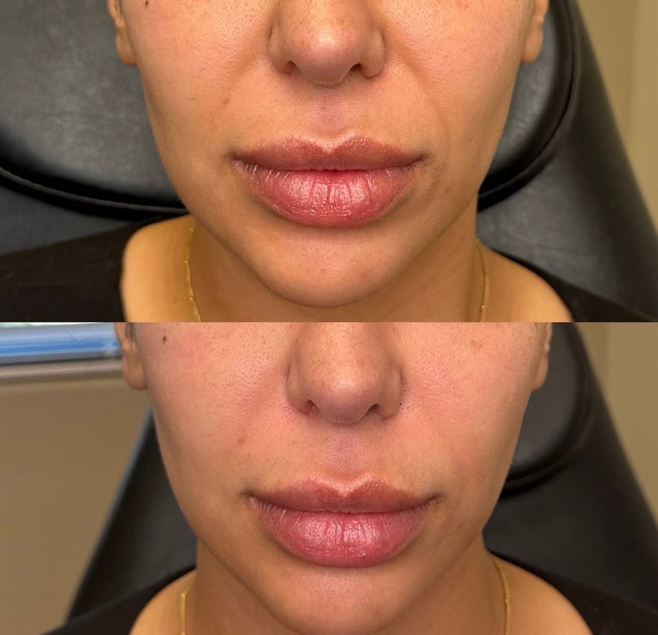Before-and-after lip filler comparison. Top: Before. Bottom: After, fuller lips. Fair skin, gold chain.