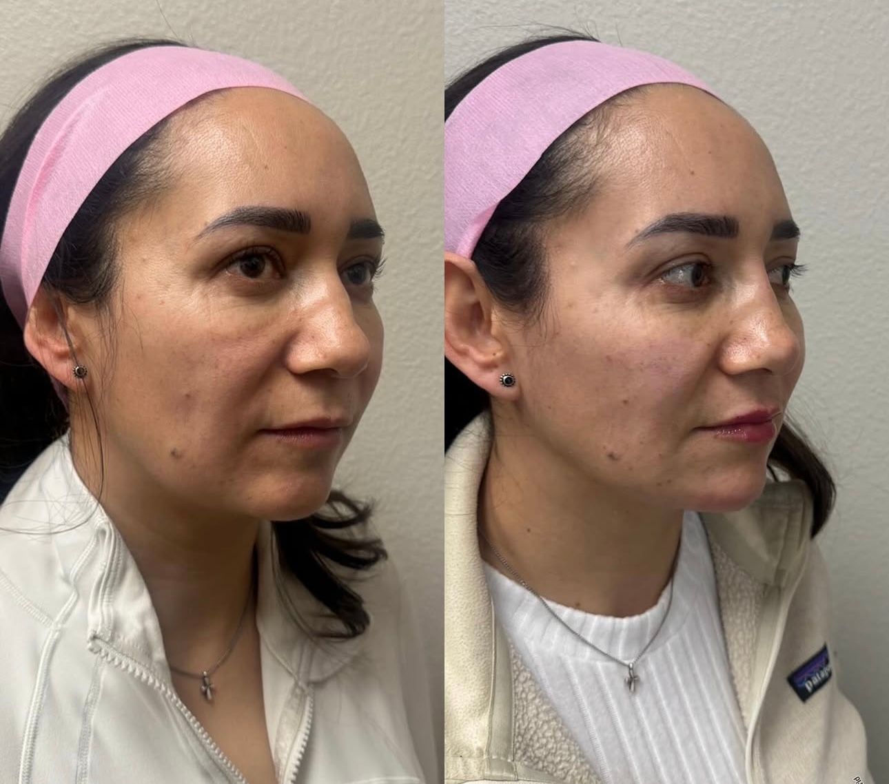 Before and after photos of a woman's face. Side profile shows a subtle change after a cosmetic procedure.