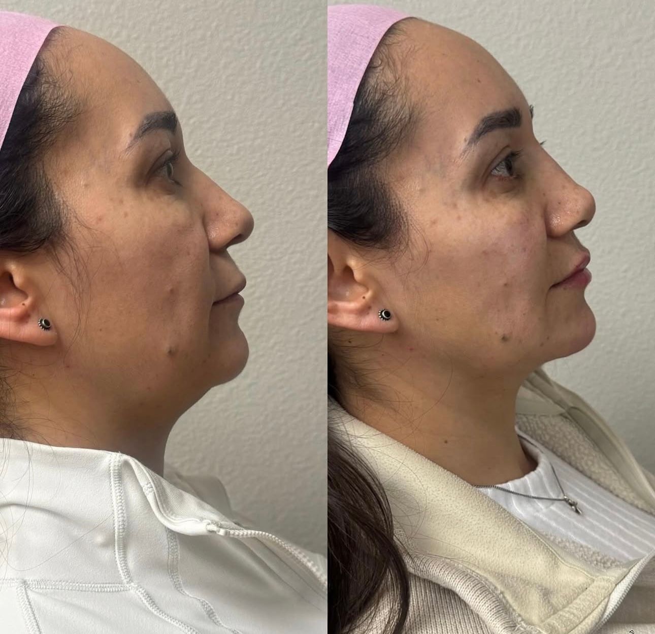 Before-and-after profile view showing a woman's chin with a visible improvement after a procedure.