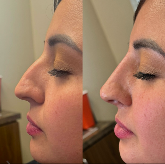 can i take glutathione after rhinoplasty Gluta Brighten Face Pack ✨, Suitable for all skin types, Enriched with 10+  herbal powders 🌿, Helps reduce pigmentation & brighten skin, DM to order 💌