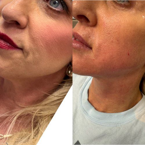 Side-by-side photos of a woman's face; one before and after a cosmetic procedure.