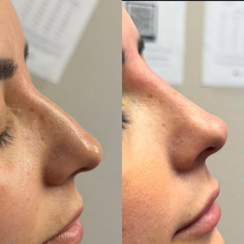 Side-by-side of a woman's nose before and after cosmetic work: more refined shape, lifted tip.