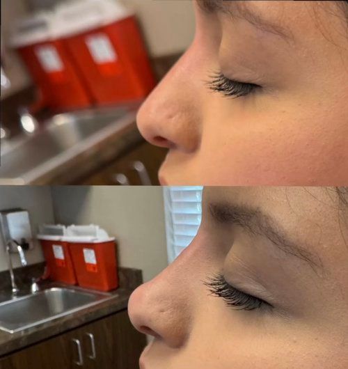 Before and after photos of a person's profile, showing a change in nose shape.