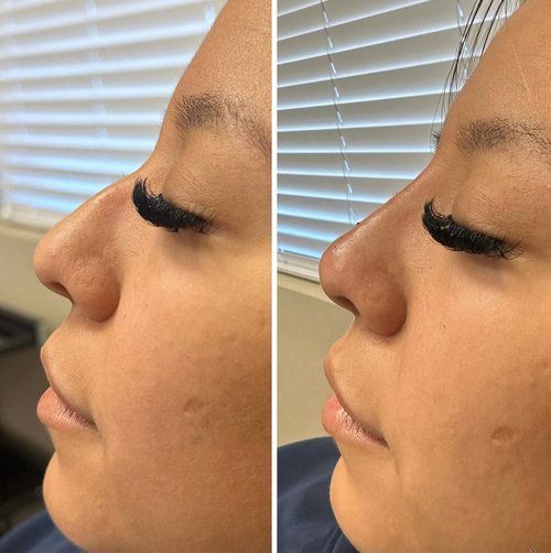 Two side-by-side photos of a woman's face showing a nose before and after a cosmetic procedure, with a straighter profile.
