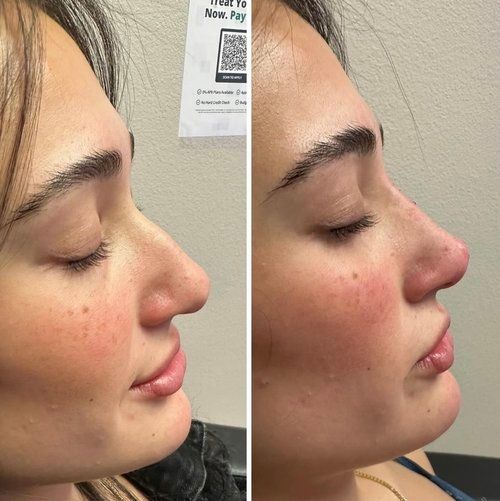 Two side-profile photos: woman before and after nose filler; showing a straighter nasal bridge in the 