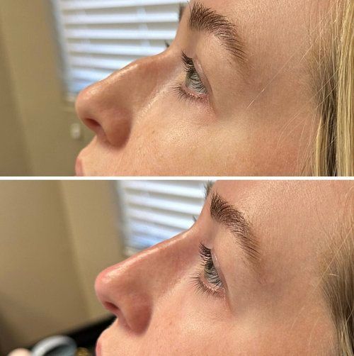 Before and after side-view comparison of a person's nose, likely showing a cosmetic procedure.