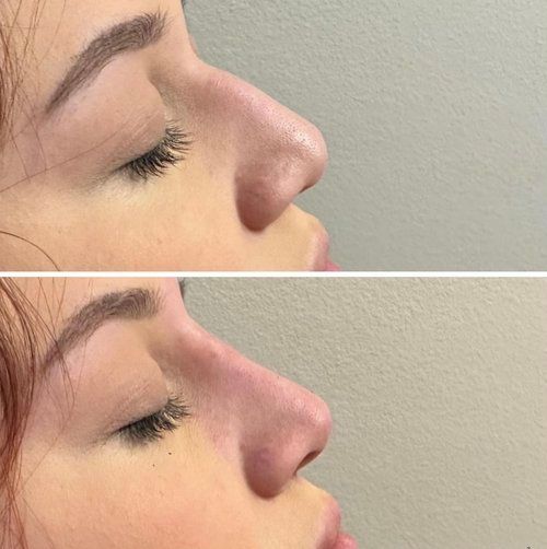 Side-by-side comparison of a woman's profile. Top: Nose before. Bottom: Nose after cosmetic work, smoother and refined.
