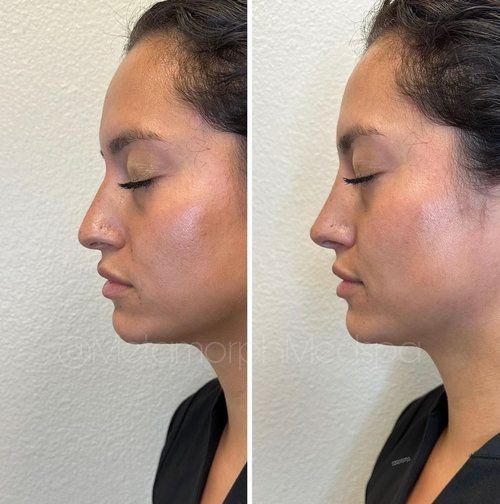 Side-by-side profile views of a woman's face before and after a cosmetic procedure, altering her nose.