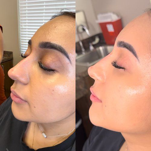 Woman's face before and after a procedure. The nose appears straighter in the 