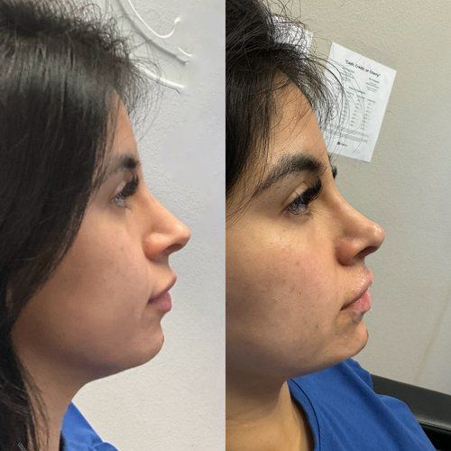 Before and after profile view of a woman's face, showing nose reshaping. Left side: profile with defined jaw. Right side: slightly different nose shape.