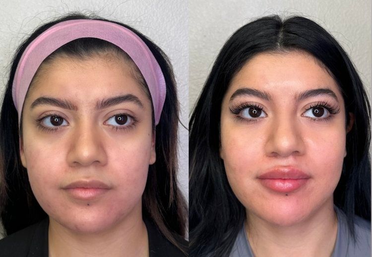 Before-and-after face comparison: woman with headband (left) and with fuller lips and makeup (right).