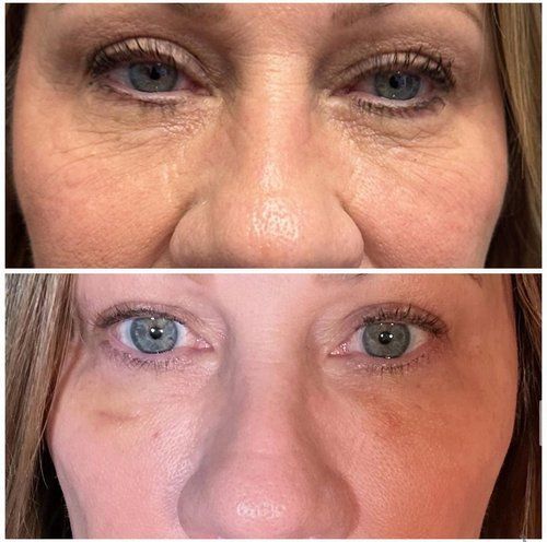 Side-by-side comparison of a woman's eyes before and after a cosmetic procedure, showing reduced wrinkles and discoloration.