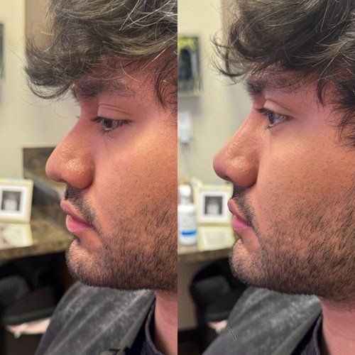 Side-by-side photos of a man's profile before and after a nose procedure. He has a smaller, more refined nose in the second photo.