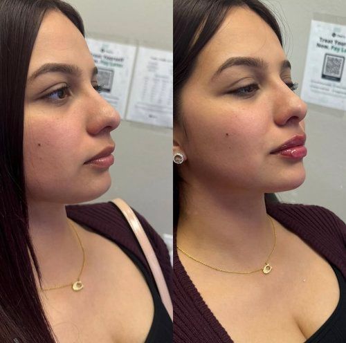 Before and after photos: woman with lip filler, smiling, wearing a gold necklace and burgundy top.