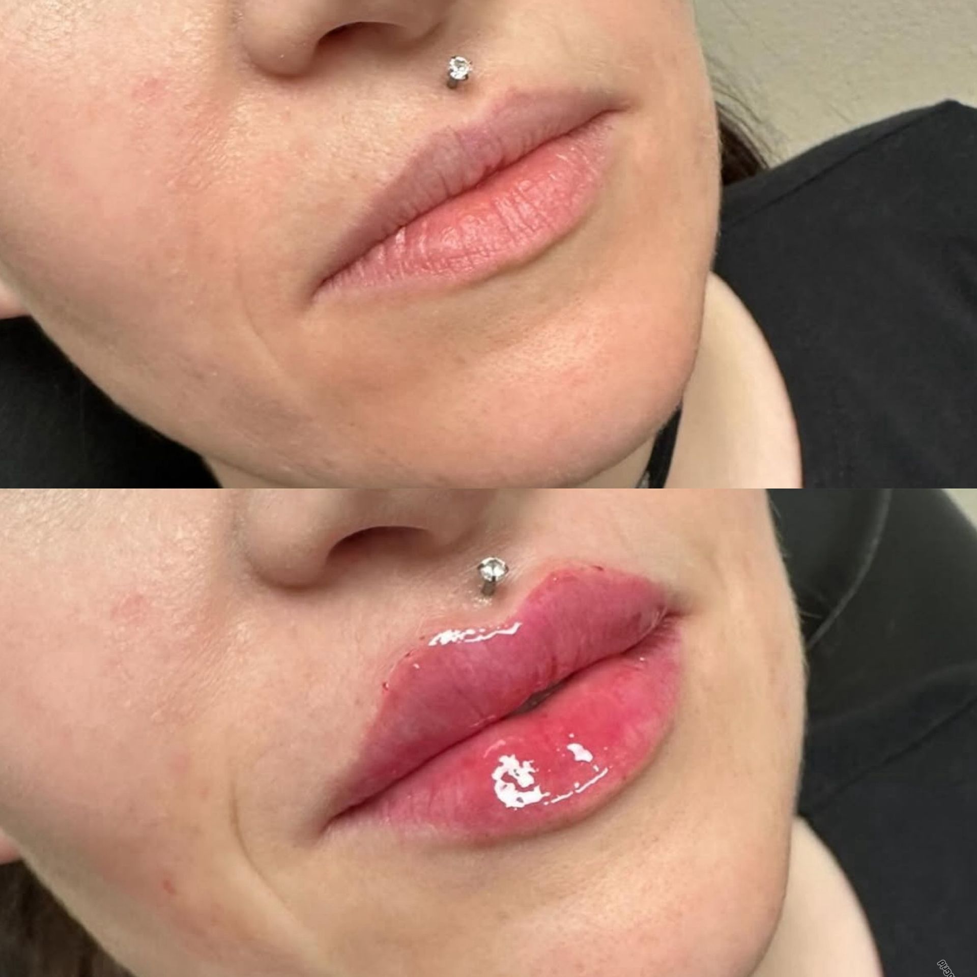 Comparison of lips before and after lip filler treatment. Top: thinner lips. Bottom: fuller, redder lips.