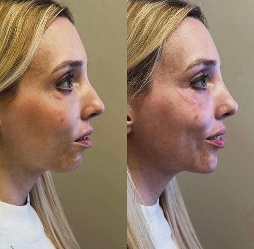 Side-by-side photos showing a woman's profile before and after a cosmetic procedure. Skin is light, blonde hair.