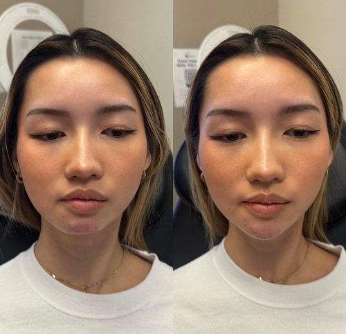 Two frontal face views of a woman before and after a cosmetic procedure. Her face has changed shape.