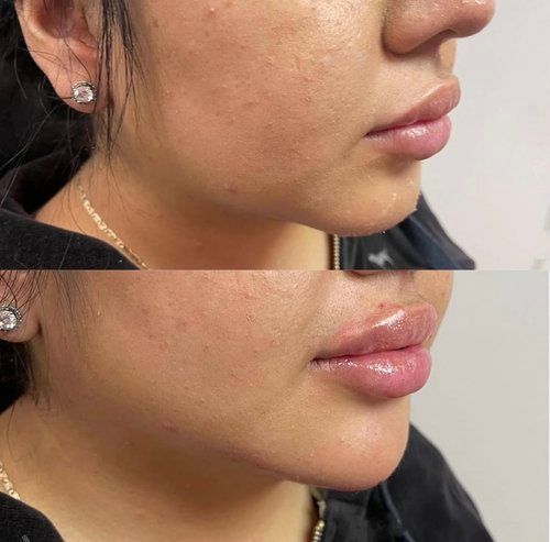 Before and after photos of lip filler, showing fuller lips.