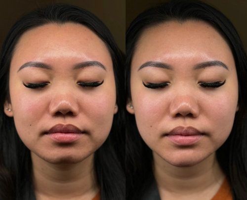 Before and after photos of a woman's face; improved skin tone, less redness.