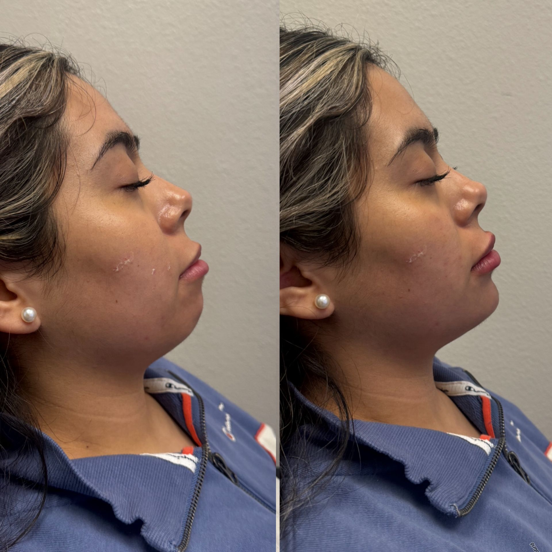 Side-by-side photos of a person. The left shows the chin before treatment and the right, after; both shots taken indoors.