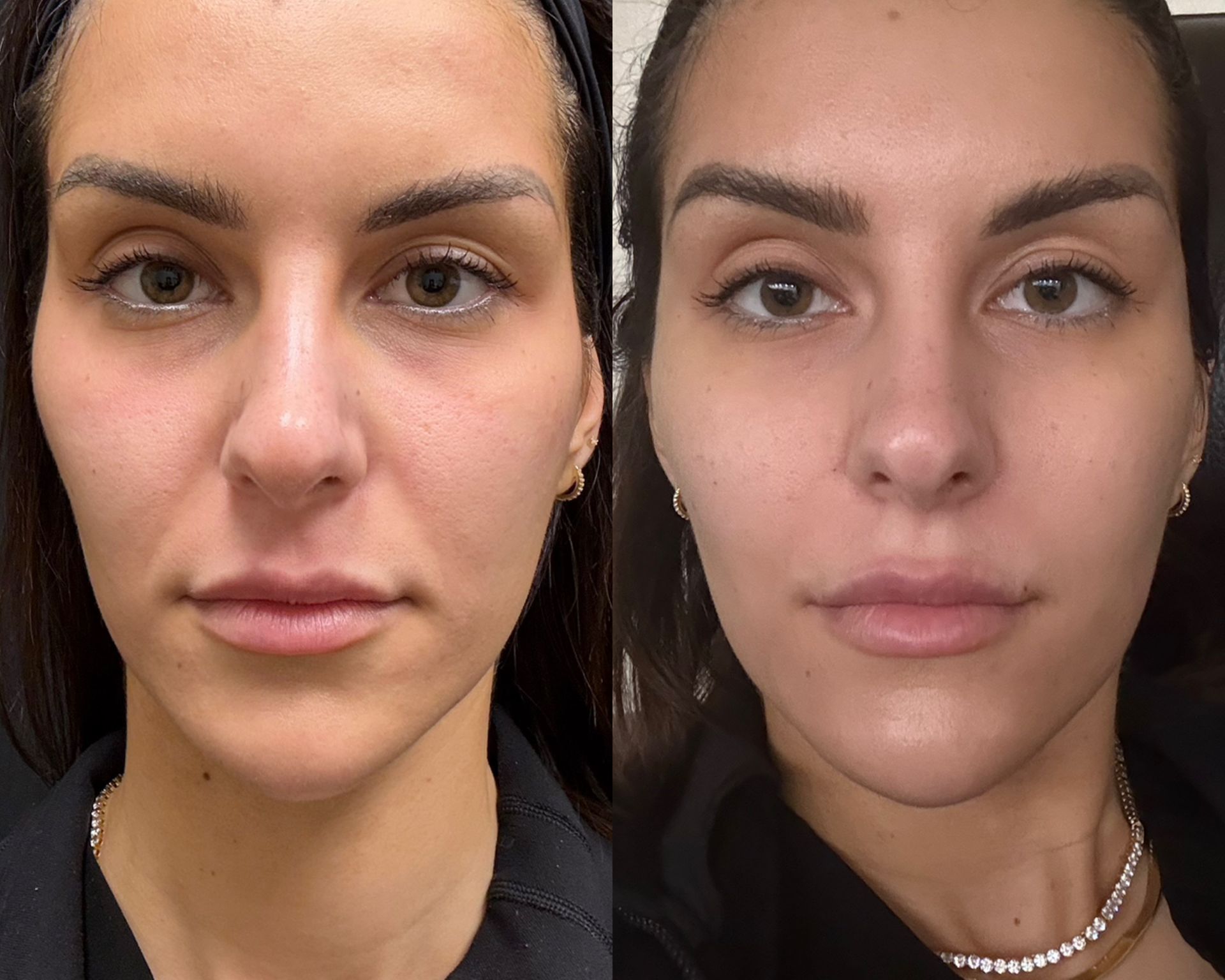 Side-by-side photos of a person's face. Left shows before, right shows smoother skin and fuller lips.