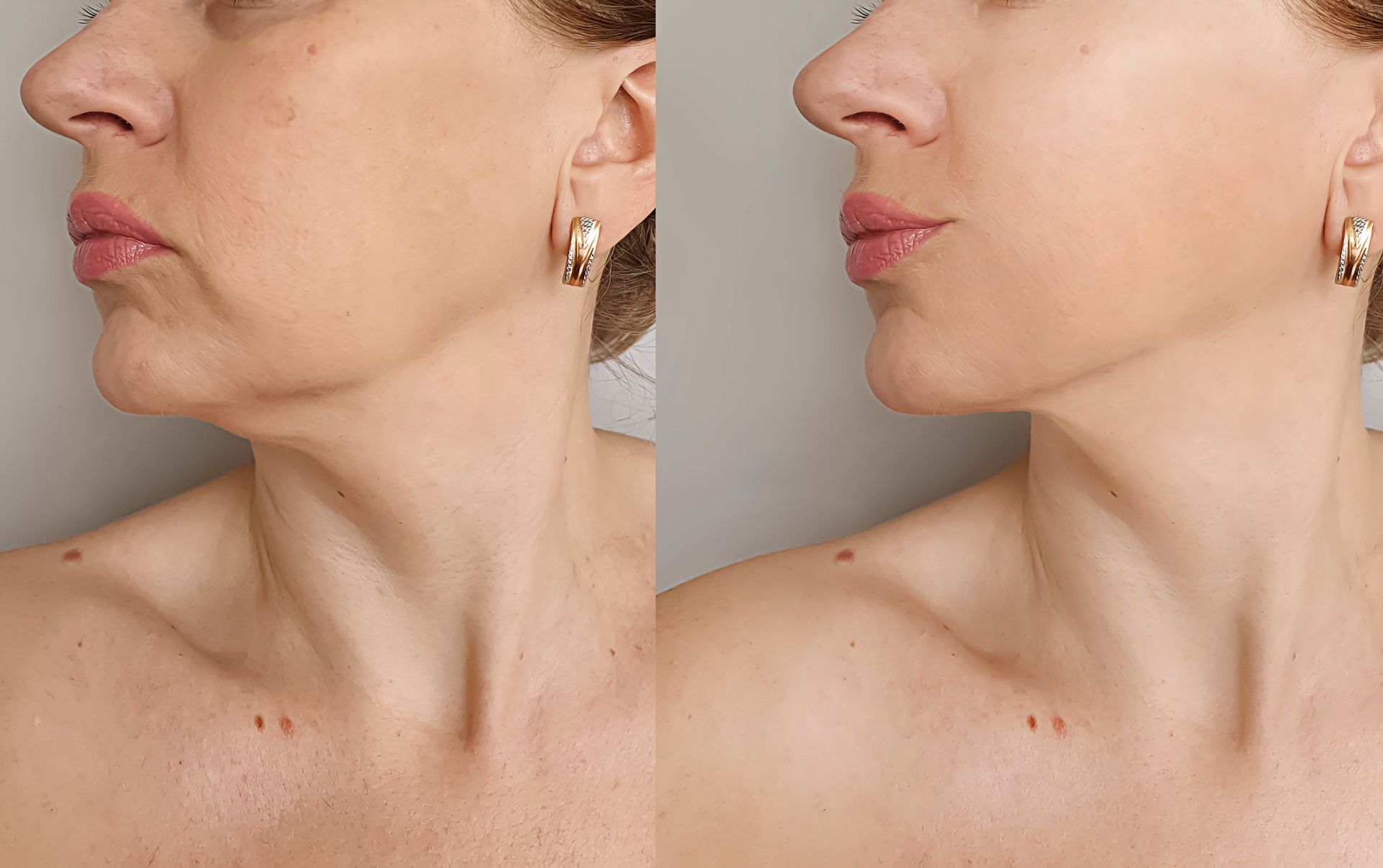 Side-by-side comparison of a woman's face and neck, showing a before-and-after anti-aging appearance.