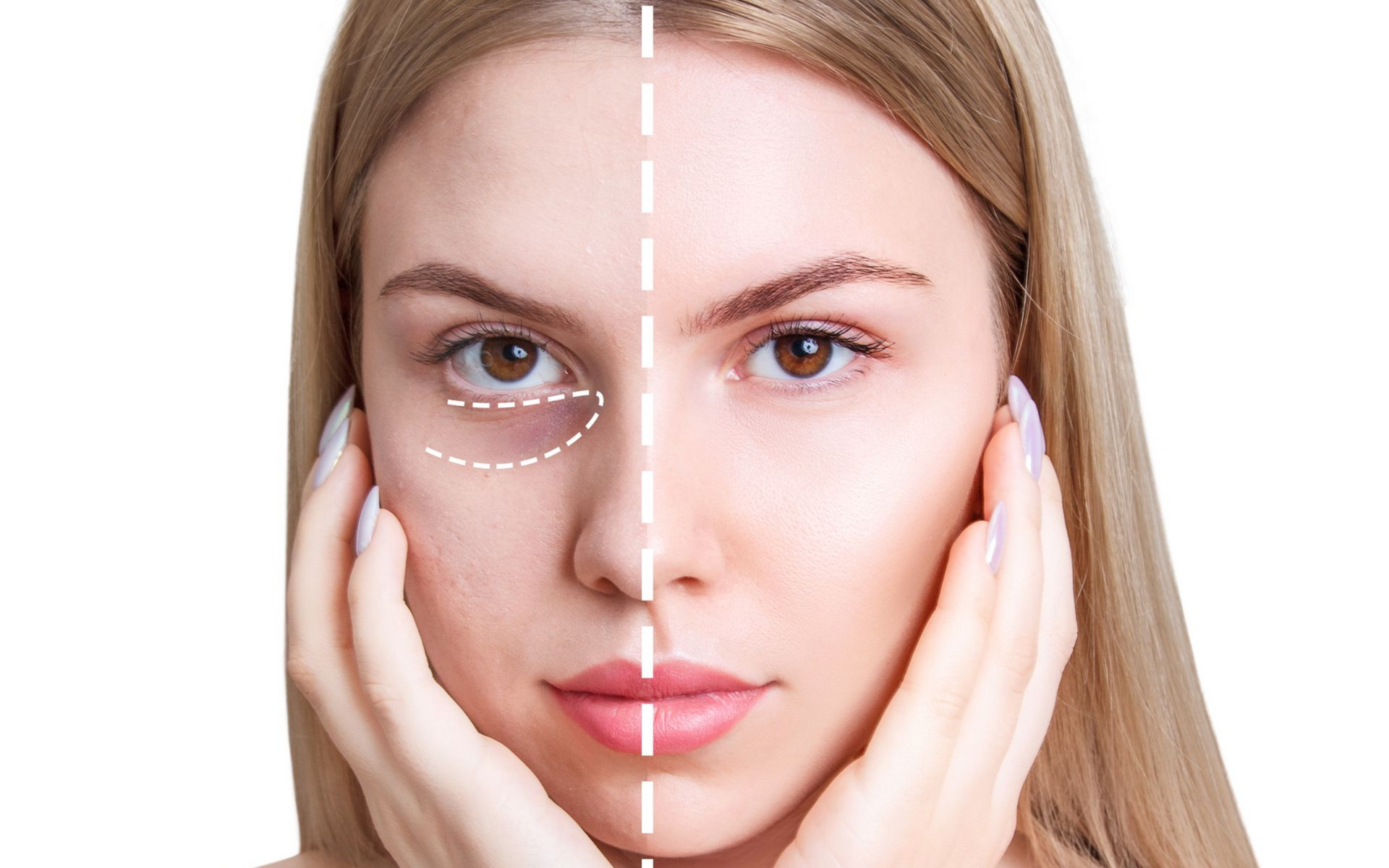 Woman's face, split: one side with dark under-eye circles, the other smooth.